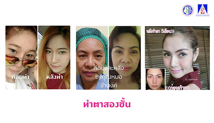 ทำตาสองชั้น ทำตาสองชั้น