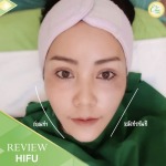 HIFU เชียงราย - คลินิกศัลยกรรม เชียงราย Chic Clinic