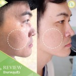 คลินิก รักษาหลุมสิว เชียงราย - คลินิกศัลยกรรม เชียงราย Chic Clinic