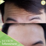 โบท็อกหน้าฝาก เชียงราย - คลินิกศัลยกรรม เชียงราย Chic Clinic