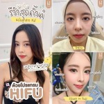 Hifu รัชดา - บริษัท เคเจ คลินิก จำกัด