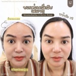 ฉีดโบท็อกอินทามระ - บริษัท เคเจ คลินิก จำกัด