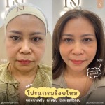 ร้อยไหม รัชดา - บริษัท เคเจ คลินิก จำกัด