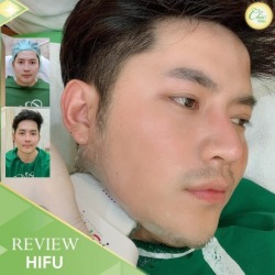 ทำ HIfu เชียงราย