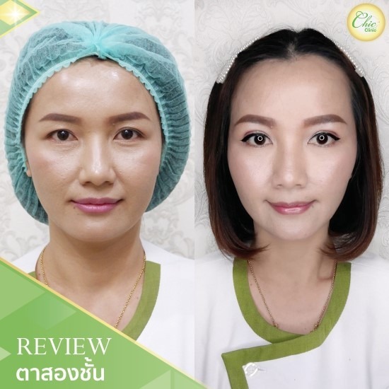 ทำตาสองชั้น เชียงราย ทำตาสองชั้น เชียงราย 
